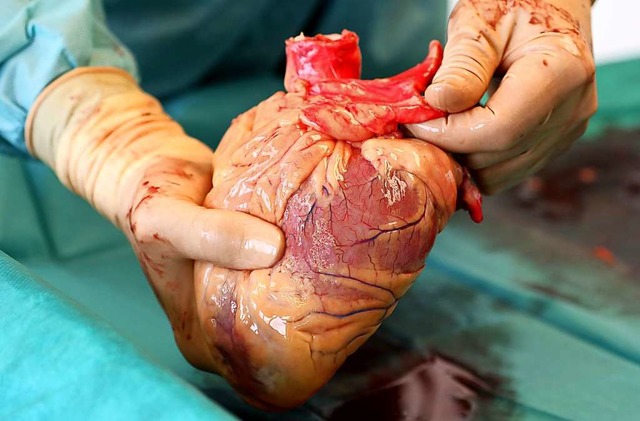 Ein Transplantationsarzt hlt das Herz...nden, das kurz zuvor entnommen wurde.  | Foto: Bernd Wstneck (dpa)