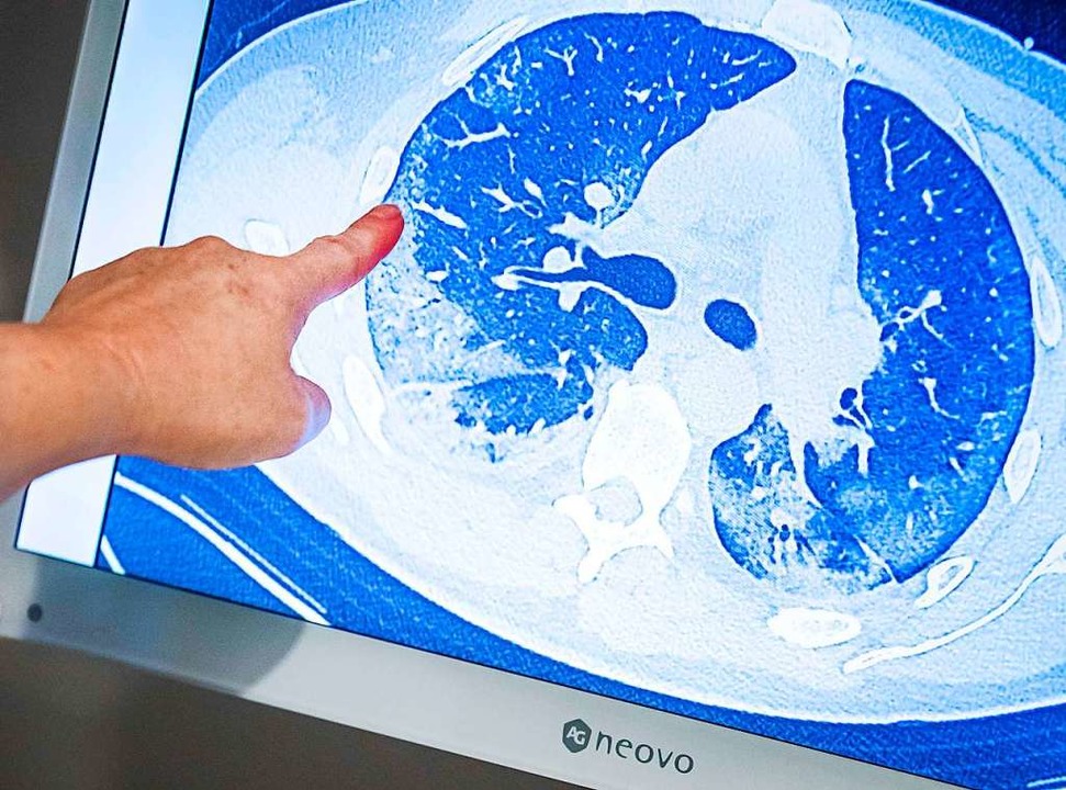 CT-Aufnahme der Lunge eines Covid-19-Patienten  | Foto: "remko De Waal"