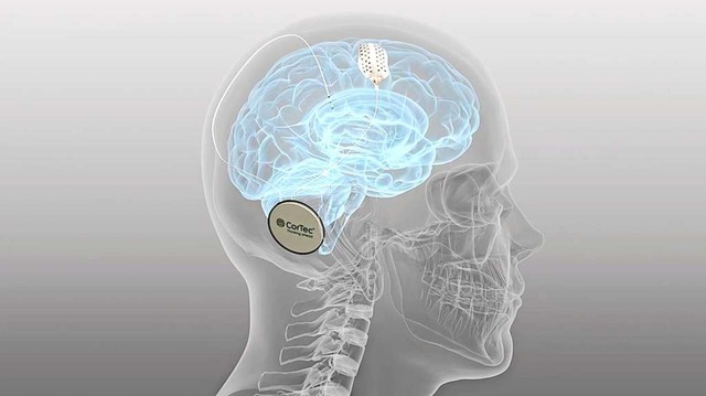 Hightech-Medizintechnik  aus Sdbaden:  das Cortec-Implantat mit Elektrode  | Foto: Cortec