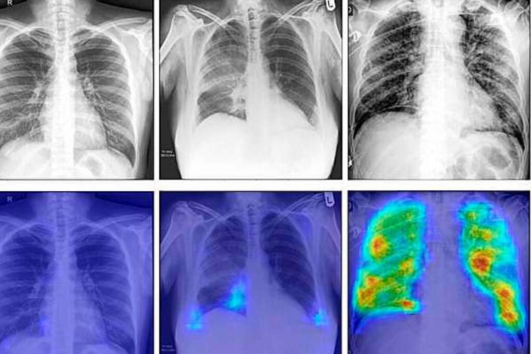 Diese Röntgenaufnahmen zeigen von link...dung, und die eine Covid-19-Infektion.  | Foto: -