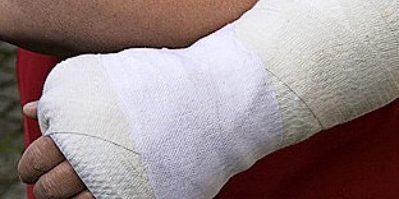 Gips juckt gebrochen arm Jucken heilende