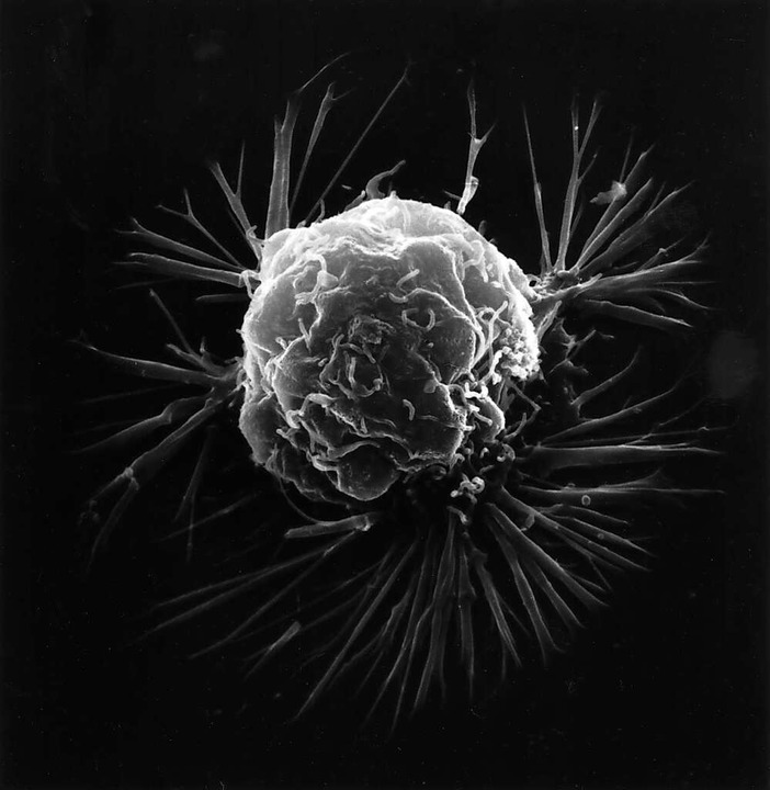 So sieht Brustkrebs unterm Mikroskop aus.  | Foto: ce: National Cancer Institute