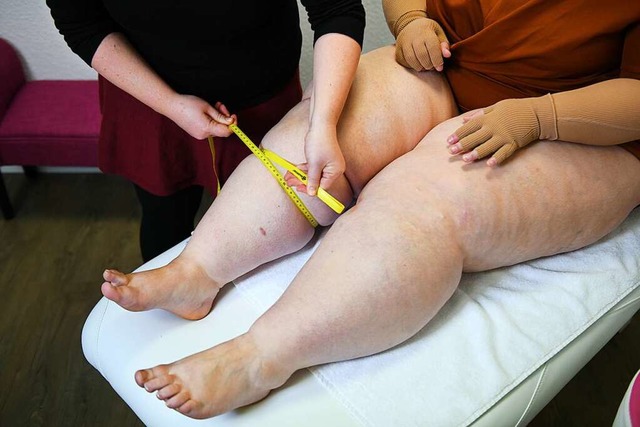 Vermutlich hormonell bedingt: Verdickt... an den Beinen einer Lipdempatientin.  | Foto: via www.imago-images.de