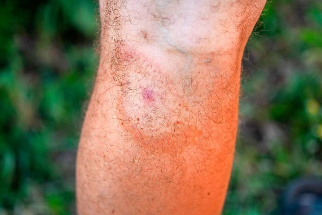Symptom einer Borreliose: ein roter Ring um den Zeckenbiss.  | Foto: androsov858 (stock.adobe.com)
