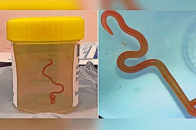Das Bild zeigt einen lebenden Spulwurm...-jhrigen Australierin gefunden wurde.  | Foto: Emerging Infectious Diseases (dpa)
