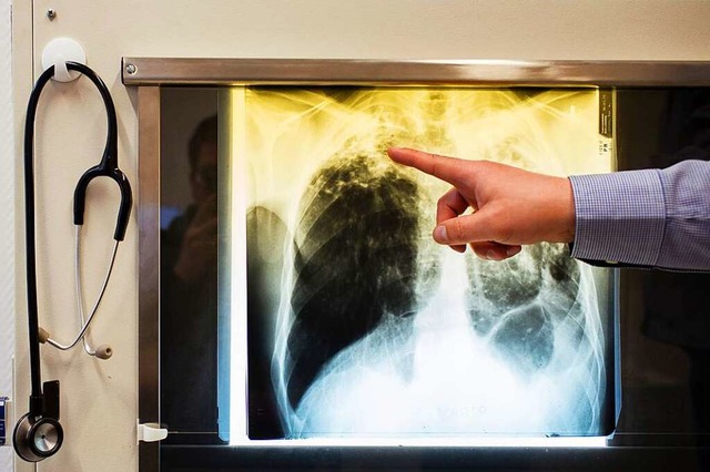 Ein Arzt zeigt einen Tuberkulose-Fall anhand eines Rntgenbildes (Symbolfoto).  | Foto: Gregor Fischer
