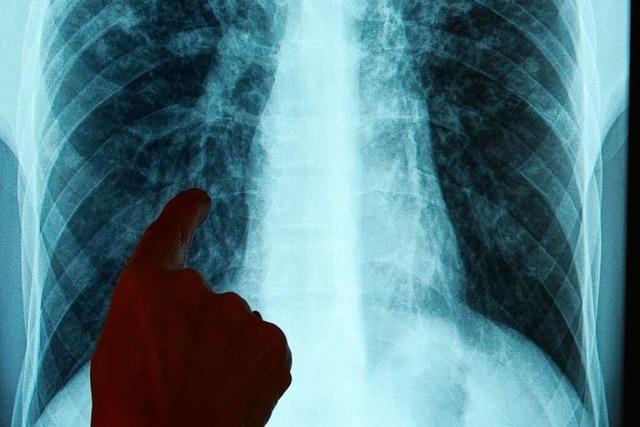 Zahl der Tuberkulose-Flle in Baden-Wrttemberg nimmt deutlich zu