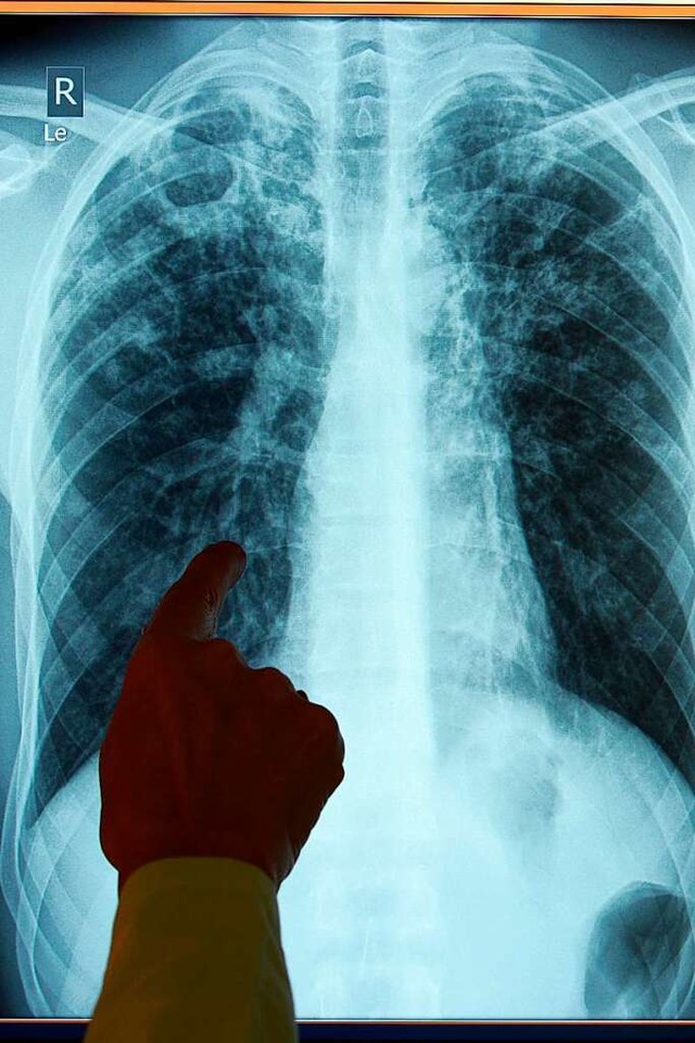 Rntgenaufnahme eines Tuberkulose-Patienten  | Foto: Rainer Jensen