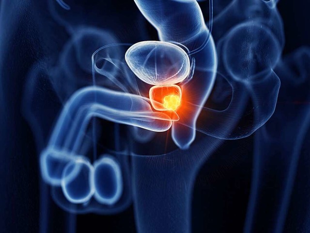 Eine grafische Darstellung der Prostat...d eines dort wachsenden Tumors (gelb).  | Foto: SciePro (stock.adobe.com)