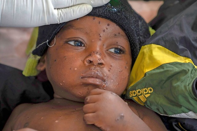 Dieses Kind ist an Mpox erkrankt.  | Foto: Moses Sawasawa (dpa)