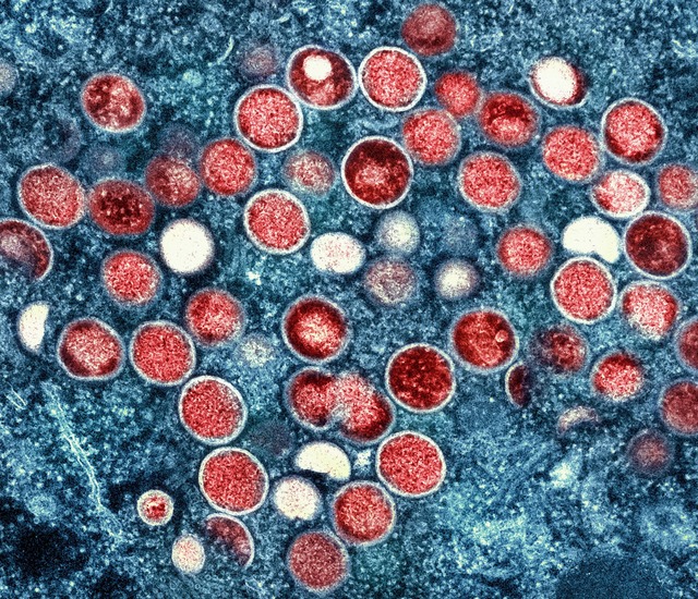 Eine eingef&auml;rbte Mikroskopaufnahme von Mpox-Partikeln.  | Foto: National Institute of Allergy and Infectious Diseases/AP/dpa