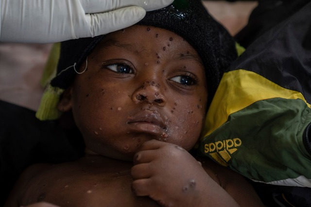 Ein an Mpox erkrankter zweij&auml;hrig...enhaus in Kamituga im Osten des Kongo.  | Foto: Moses Sawasawa/AP