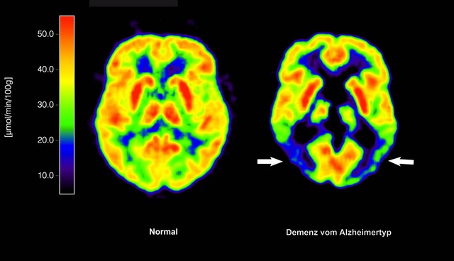 Haben die Amyloid-Plaques schon irreve...e Entfernung nichts mehr. (Archivbild)  | Foto: picture alliance / dpa