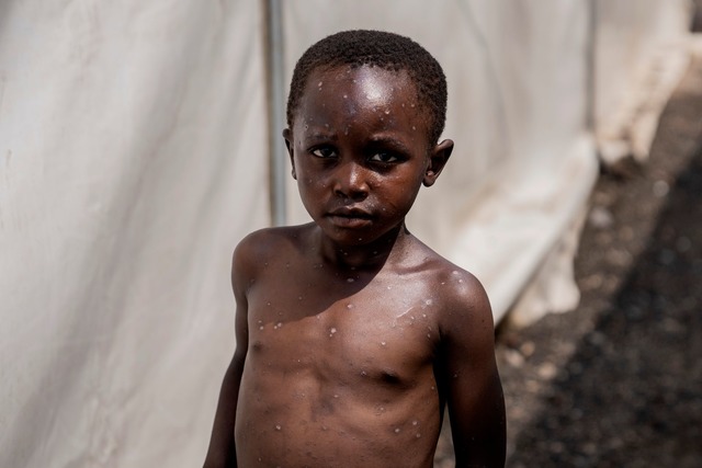 F&uuml;r Kinder kann Mpox besonders gef&auml;hrlich sein (Archivbild)  | Foto: Moses Sawasawa/AP/dpa