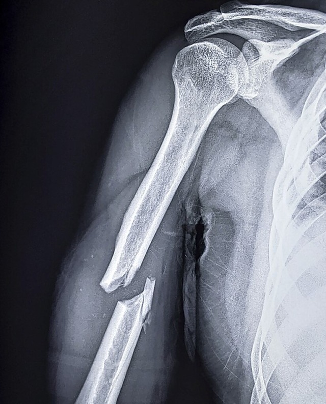 Am besten heilt ein Knochen, der glatt durchgebrochen ist.  | Foto: Susmit (stock.adobe.com)