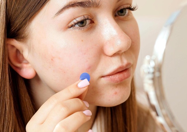 Anti-Pickel-Pflaster fürs Gesicht: Pim... sollen gegen Hautunreinheiten helfen. | Foto: IMAGO/Yay Images Anti-Pickel-Pflaster fürs Gesicht: Pim... sollen gegen Hautunreinheiten helfen. | Foto: IMAGO/Yay Images